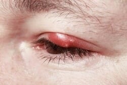 recurring chalazion can have ill effects