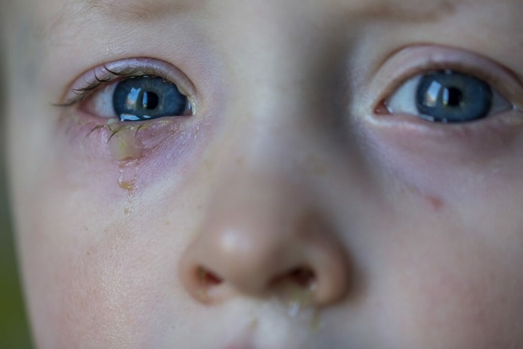 2 Year Old With Cold And Eye Discharge