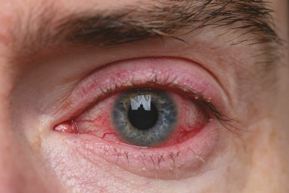 4 Best Indicators of Dry Eye in Rosacea
