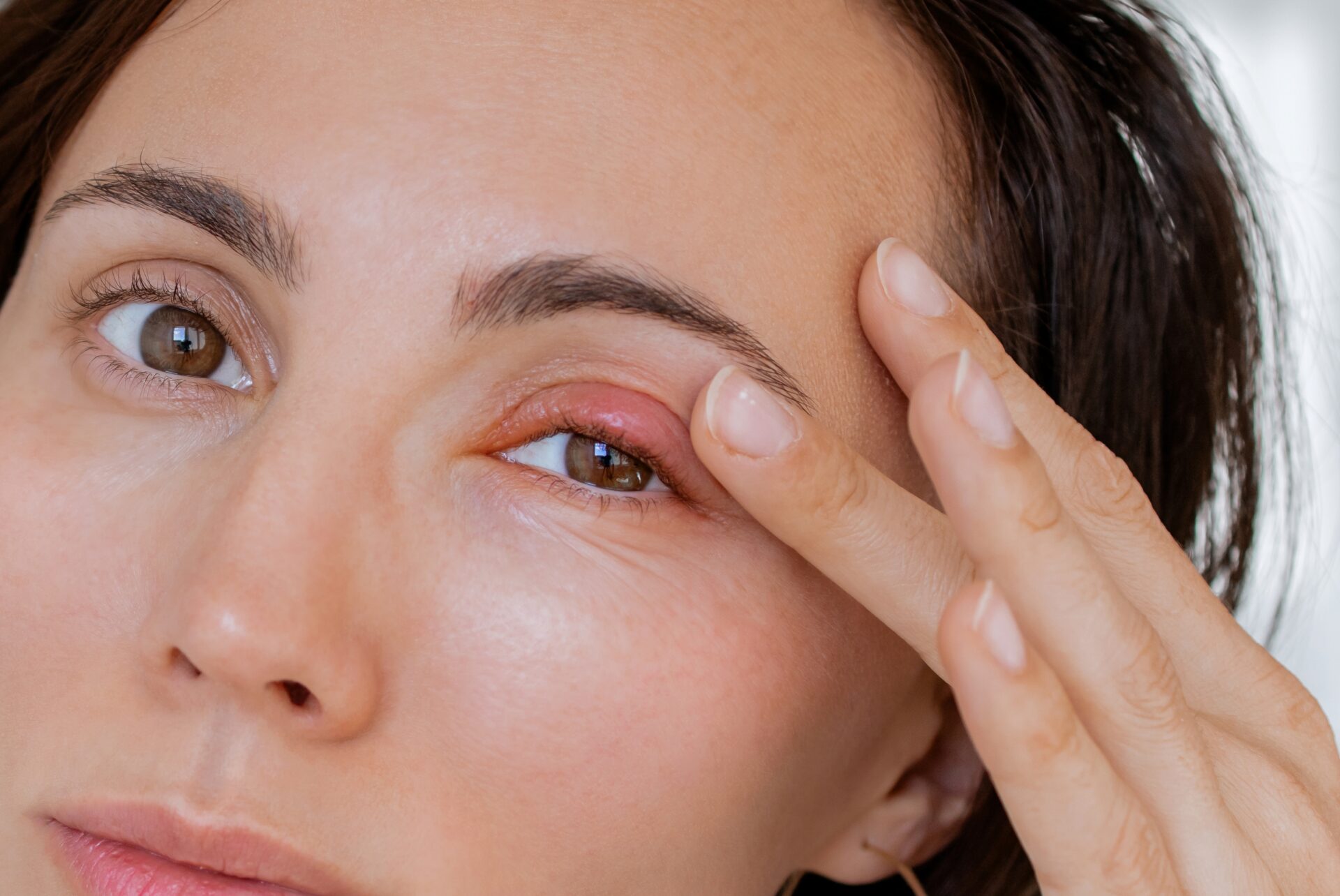 Amazing Chalazion Treatment: 9 Key Steps For Steroid Injection Aftercare