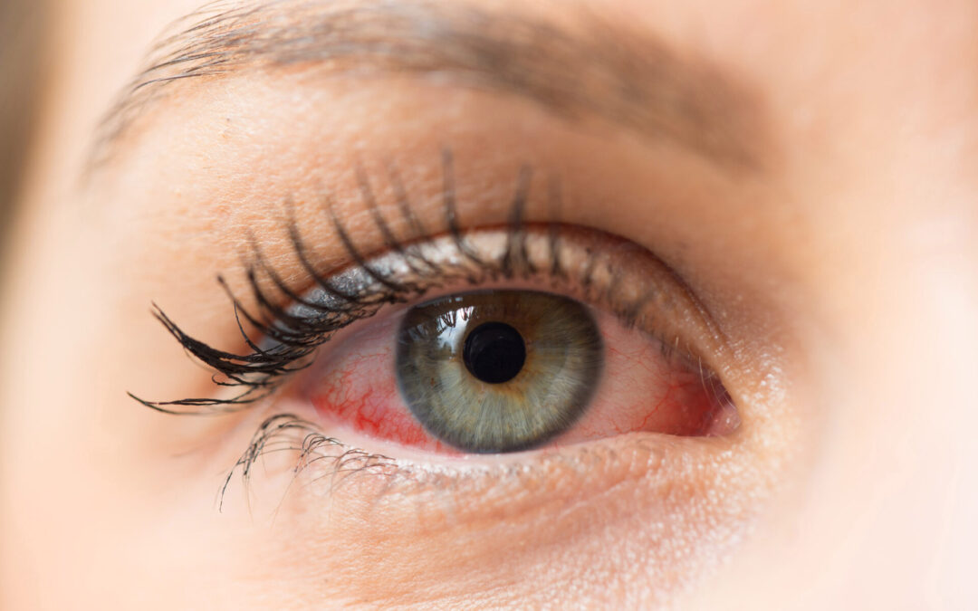 Ocular Rosacea – Amazing Four Effective Natural Remedies
